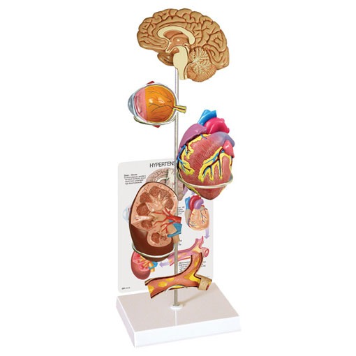 Hypertension Set - Budget Anatomical Model