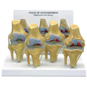 Four-Stage Osteoarthritis Knee - Budget Anatomical Model
