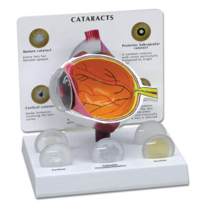 Cataract Eye - Budget Anatomical Model
