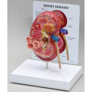 Kidney Cancer - anatomical Model