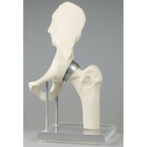 Hip Joint Implant - Anatomical Model