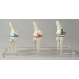 Knee Implant - Anatomical Model